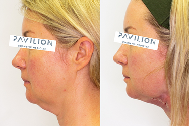 FaceTite And AccuTite Non-Surgical Facelift | Pavilion Cosmetic