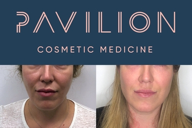 FaceTite And AccuTite Non-Surgical Facelift | Pavilion Cosmetic